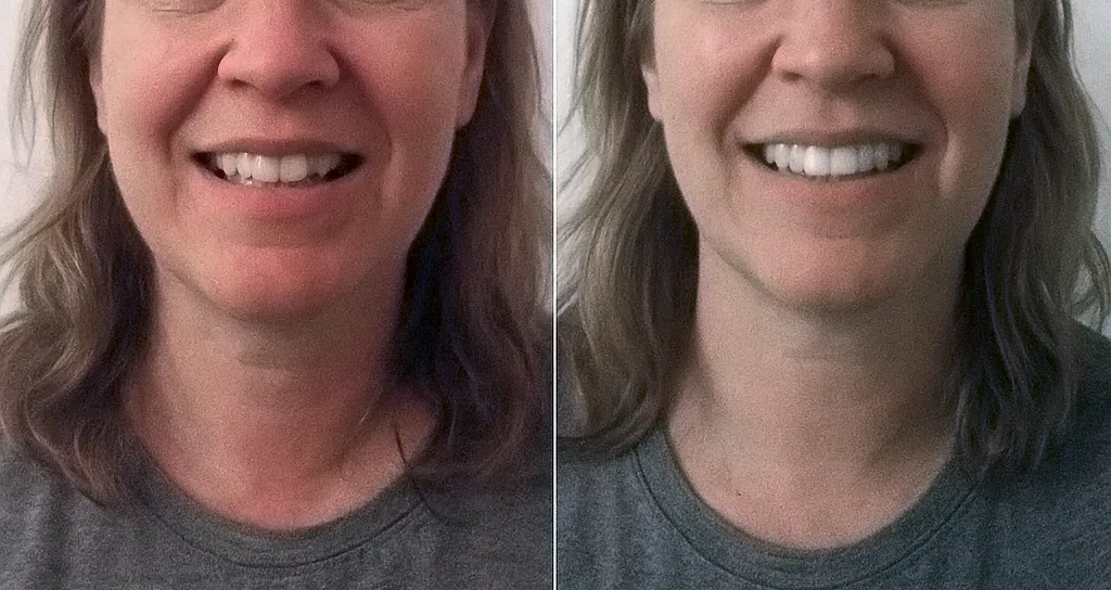 Restauración dental con resinas en mujer de 43 años en Chihuahua, sonrisa rejuvenecida y estética natural.